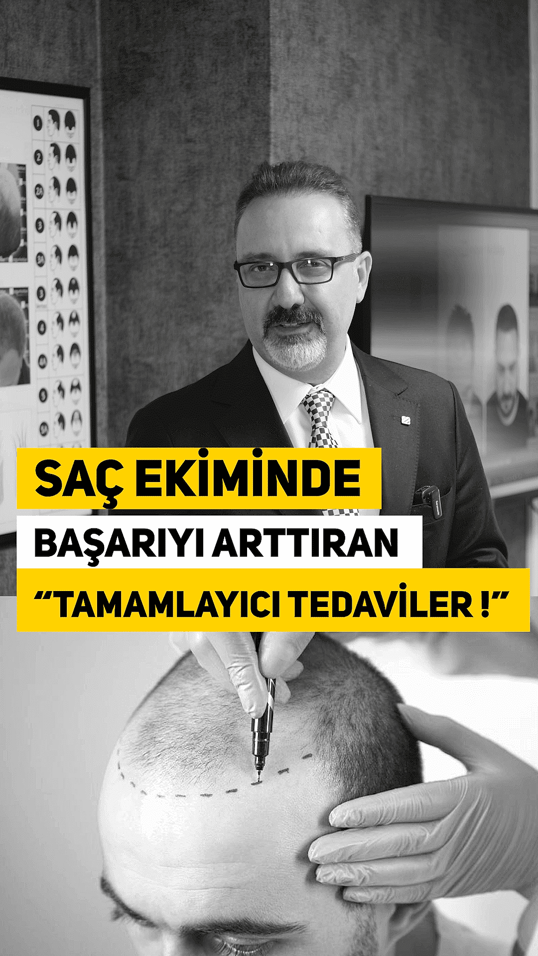 saç ekimi
